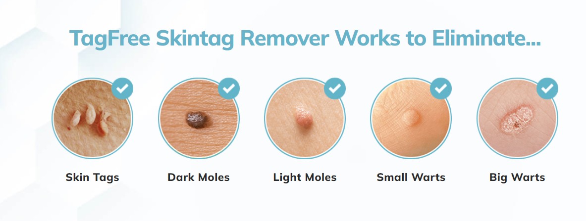 TagFree Skin Tag Remover